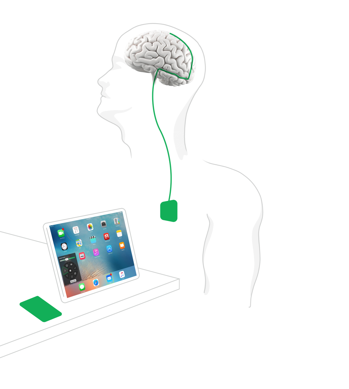 Synchron's BCI in the body: the Stentrode in a brain blood vessel, connected down and out to a tablet.